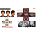 Aligner Treatment - Image 7
